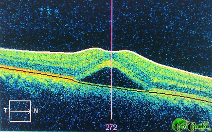 "Central serous retinopathy" by Russell Neches (Rneches) - Own work. Licensed under CC BY-SA 3.0 via Commons - https://commons.wikimedia.org/wiki/File:Central_serous_retinopathy.jpg#/media/File:Central_serous_retinopathy.jpg